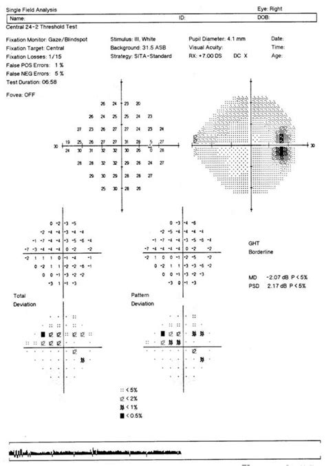 drops to test for glaucoma|The Glaucoma Eye Exam: 6 Common Tests .